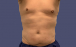 Liposuction 5 - Abdomen and Posterior Flanks Before